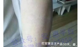 皮肤皮肤病爆料最新消息,皮肤皮肤病研究进展与防治策略解析