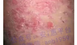 皮肤皮肤病爆料最新消息,皮肤皮肤病研究进展与防治策略解析